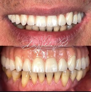 A Whiter, Stronger Smile